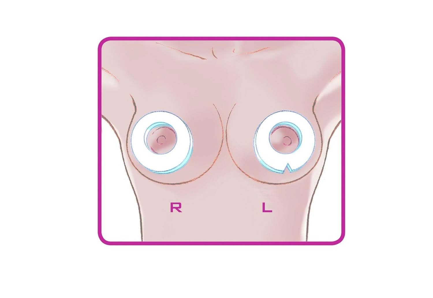 ELANEE Brust-Ringe, Schutz Der Brustwarze Bh-Kontakt Durch Hohllagerung, Ideal Bei Wunden, Entzündeten Brustwarzen Durch Stillen, 10 Stück (222-00) Akcesoria Żywność i karmienie piersią Sklep Bebe Naty